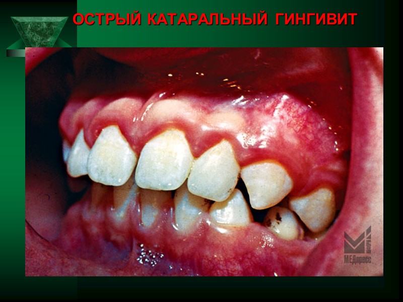 ОСТРЫЙ КАТАРАЛЬНЫЙ ГИНГИВИТ